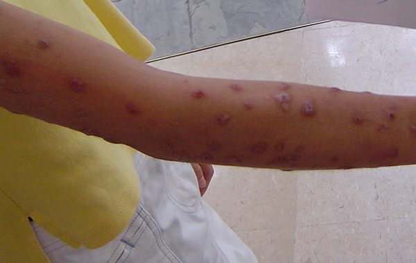 A 14 years old girl with rare chronic skin disease Prurigo Nodularis PN 结节性痒疹
