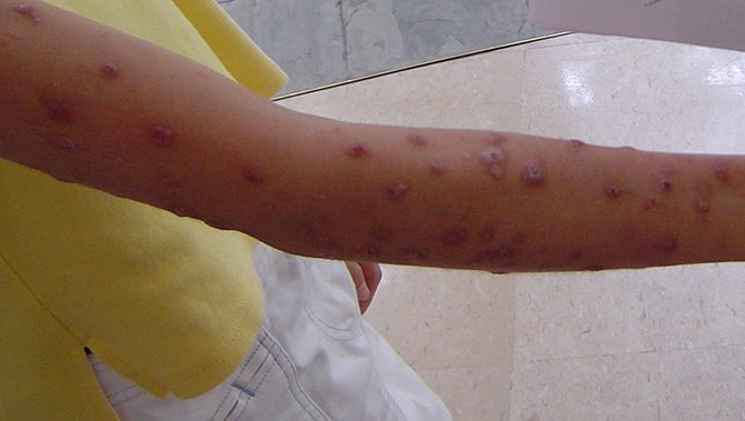 A 14 years old girl with rare chronic skin disease Prurigo Nodularis PN 结节性痒疹