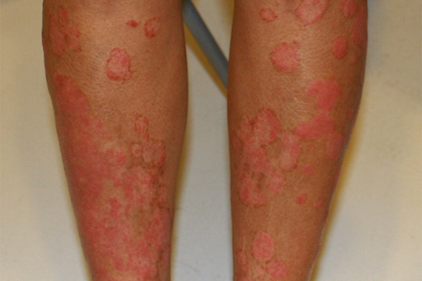 A 58-year-old woman with psoriasis vulgaris received full recovery in 6 months 银屑病