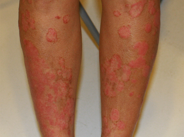 A 58-year-old woman with psoriasis vulgaris received full recovery in 6 months 银屑病