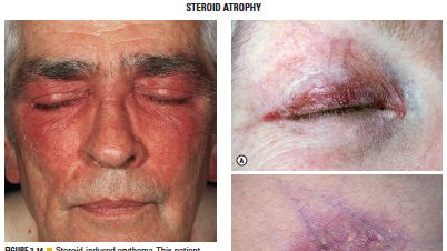 Adverse Reactions to Topical Steroids 皮质激素之副作用