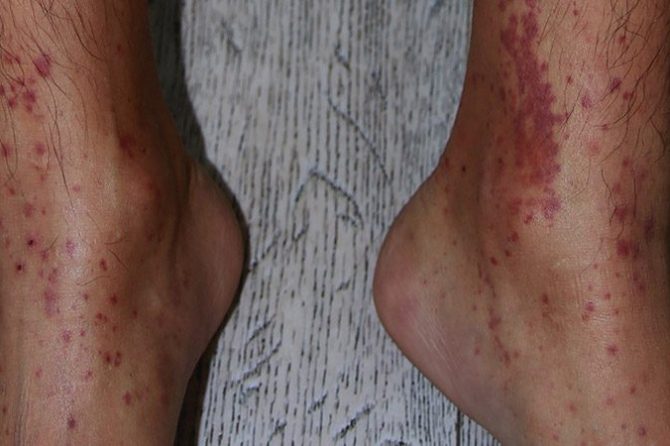 A 20-year-old previously healthy man presented with IgA vasculitis (Henoch–Schönlein purpura) 过敏性紫癜