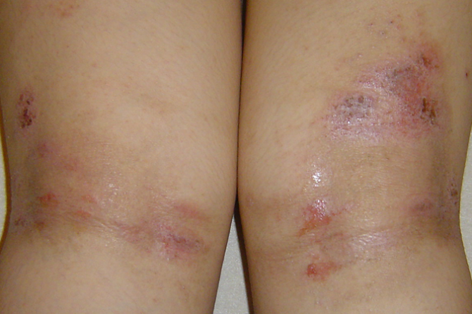 A 13-year-old girl with non-stop itching and oozing erosions and scars remained on arms and legs 湿疹