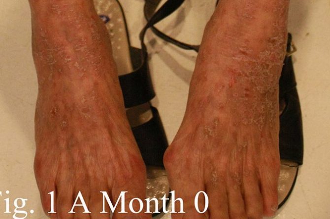 A 73-year-old woman with 4 months of pruritic eczematous skin received clearance with tangs medication in 7 months