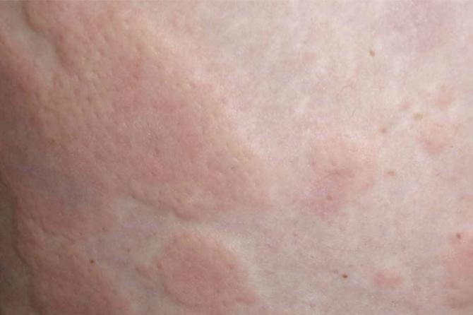 A 56-year-old woman with 20 years of chronic hives (urticaria) and 18 years of eczema 荨麻疹并发湿疹