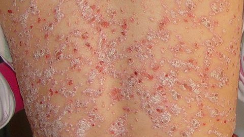 First-line therapeutic options for patient with psoriasis vulgaris at initial stage 牛皮癣初病治疗效果快