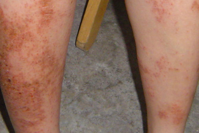 A 40-year-old woman with severe itch and crusted rashes resistant to steroid, cyclosporine 类固醇、环孢霉素治疗无效的顽固湿疹