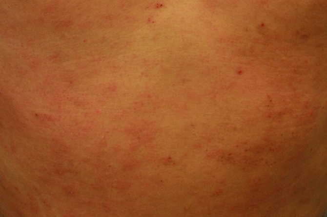 A 29-year-old man with 17 years of prurigo papules and eczematous skin lesions 湿疹