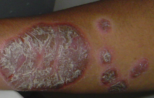 A 35-year-old man with 7 years of thick whitish scale on reddish plaque 银屑病