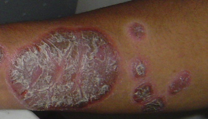 A 35-year-old man with 7 years of thick whitish scale on reddish plaque 银屑病