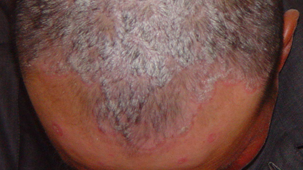 A 43-year-old man with diffused silvery scales adherent entire scalp and salmon-pink papules on forehead and face. scalp psoriasis 头皮银屑