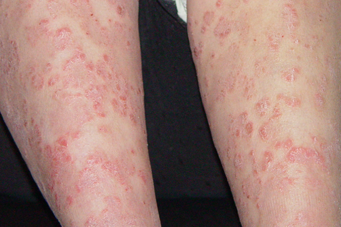 A 13-year-old girl with reddish psoriatic plaques on lower limbs 银屑病