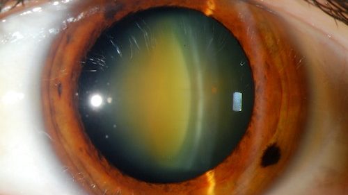 Topical corticosteroids may be associated with cataracts in children as well as adults 类固醇与白内障