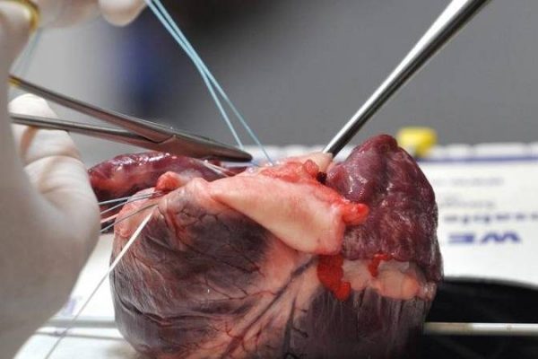 Multi-organ damage induced by anabolic steroid supplements 合成代谢类固醇与器官衰竭