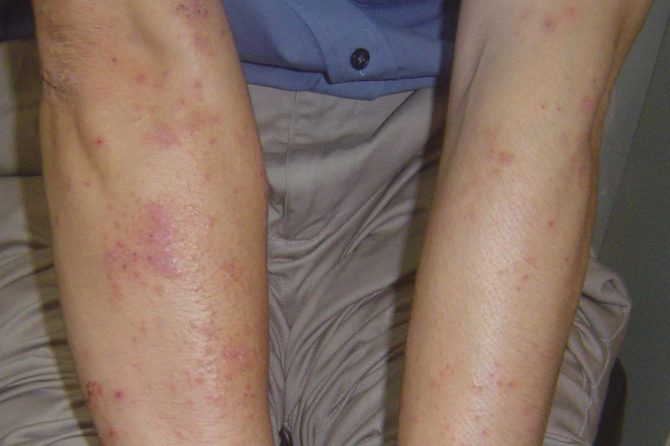 Eczema Testimony from 35-yr-old male Singaporean