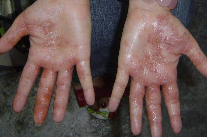 Eczema Testimony from Michelle, Singapore