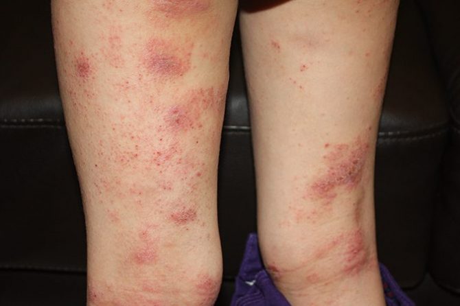 Eczema Testimony from Ms Lum, Singapore