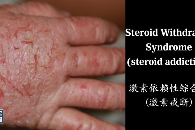 A Systematic Review of Corticosteroid Withdrawal Syndrome 激素戒断综合征