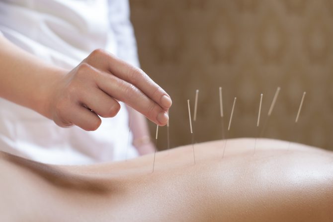 Psoriasis Flare from Koebner’s Phenomenon after Acupuncture 针灸导致银屑病同形反应