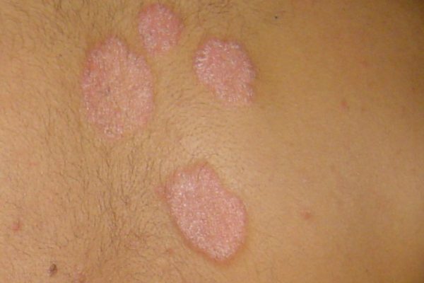 Testimony from Clarence, Singapore, psoriasis 银屑病