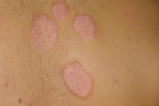 Testimony from Clarence, Singapore, psoriasis 银屑病