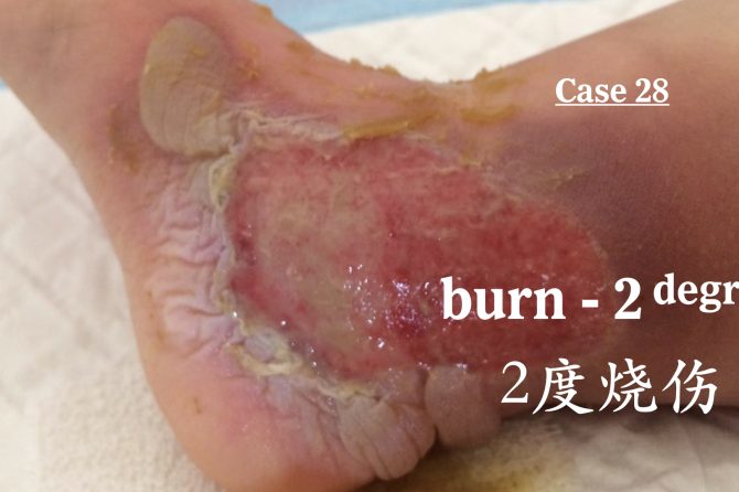 Management of 2nd-degree Burns 二度烧烫伤的治疗