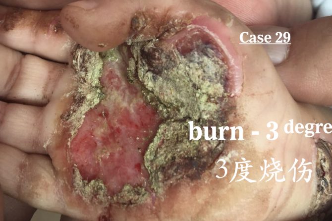 Management of 3rd-degree Burns 三度烧烫伤的治疗