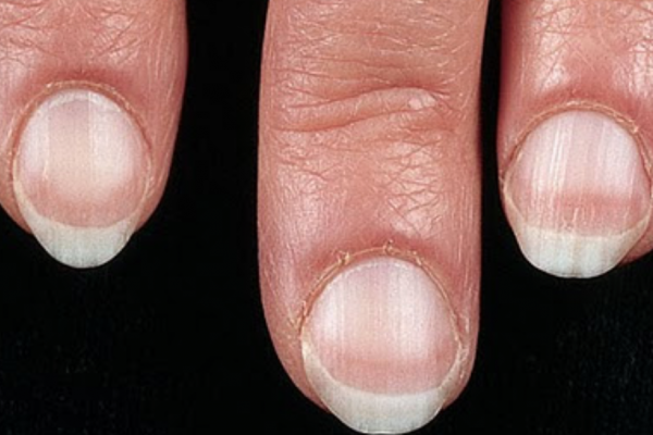 Nail Signs Apparent Leukonychia 表相白甲
