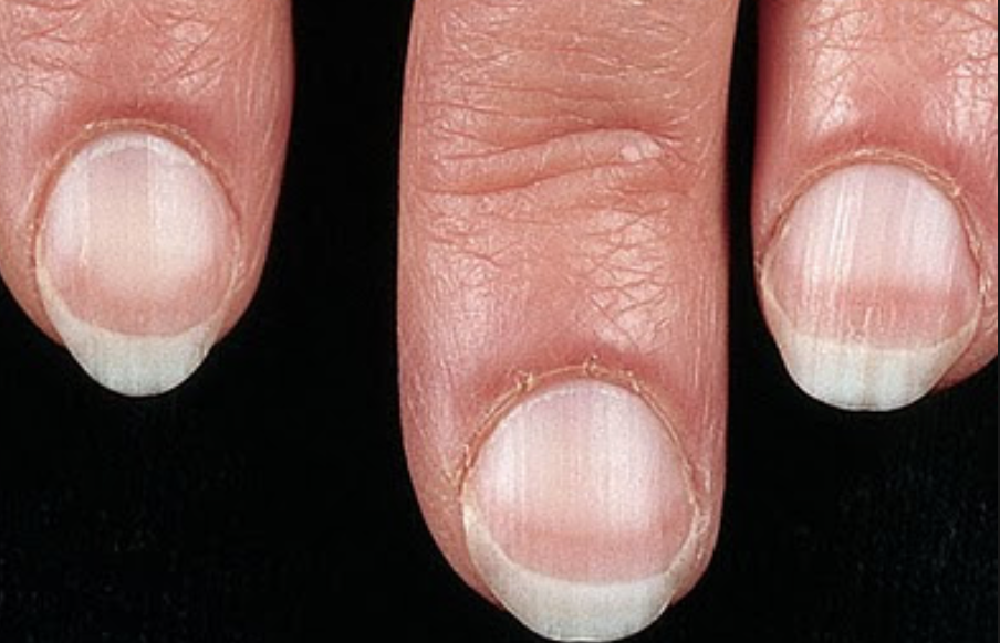 Nail Signs Apparent Leukonychia 表相白甲