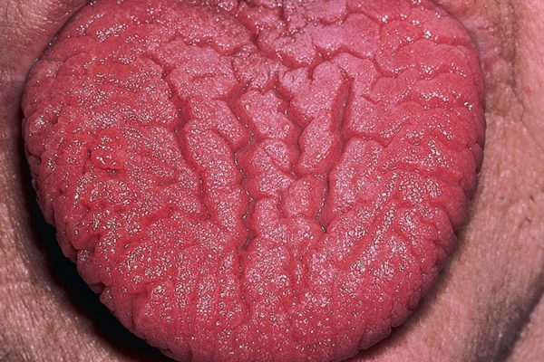 Fissured Tongue 沟裂舌