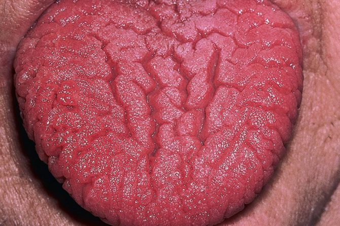 Fissured Tongue 沟裂舌