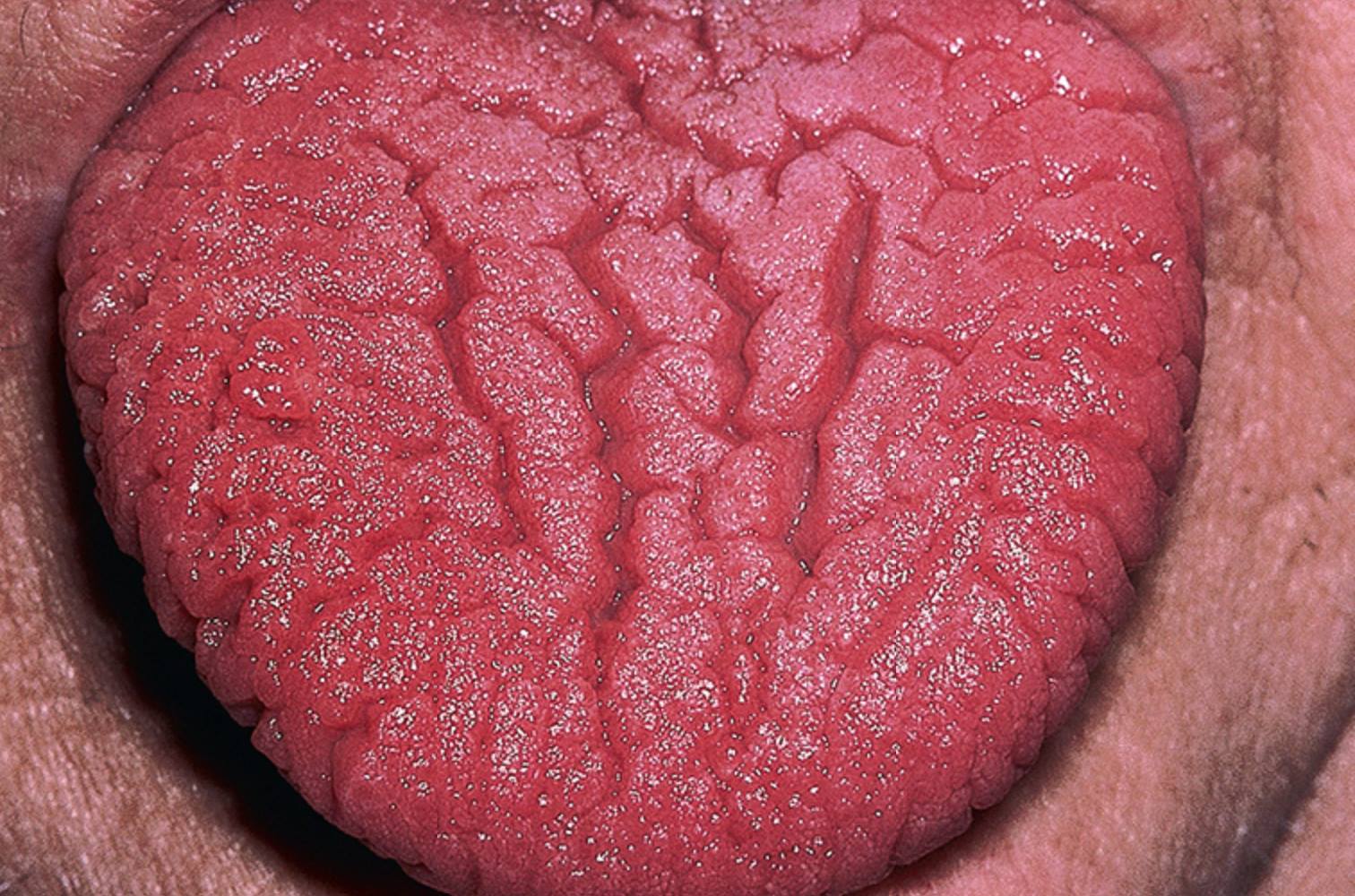 Fissured Tongue 沟裂舌