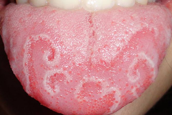 Geographic Tongue 地图舌