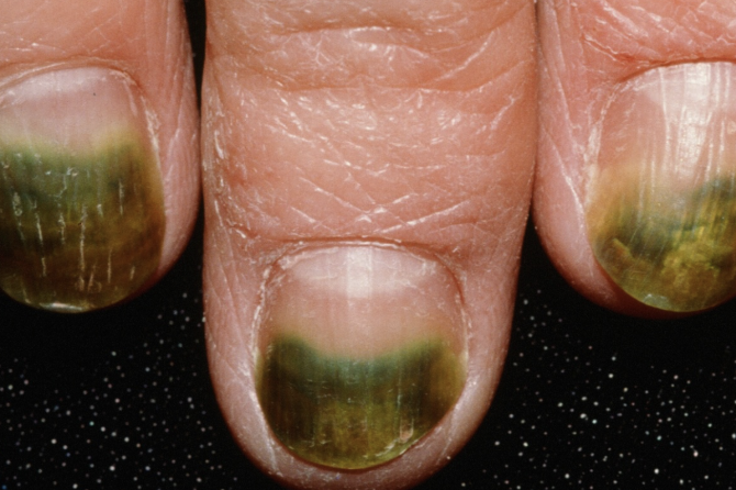Nail Signs Green nail syndrome 绿甲综合征