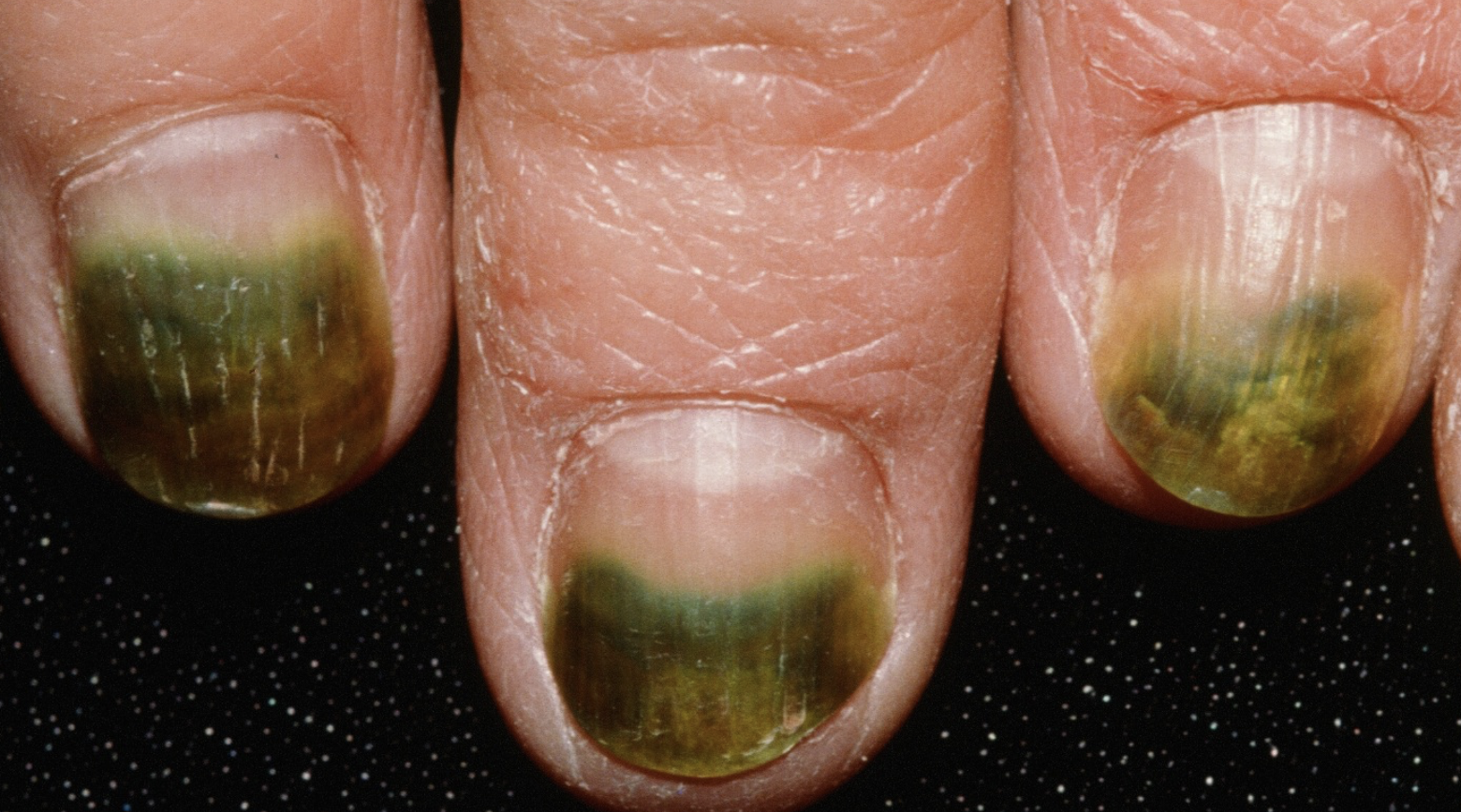 Nail Signs Green nail syndrome 绿甲综合征