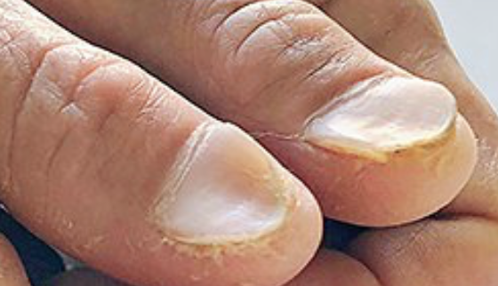 Nail Signs Koilonychia (spoon nails) 反甲