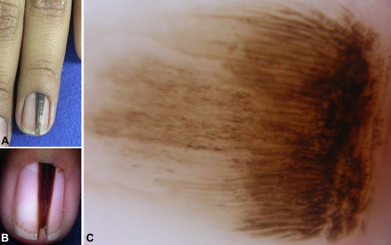 Nail Signs longitudinal melanonychia 纵向黑色素