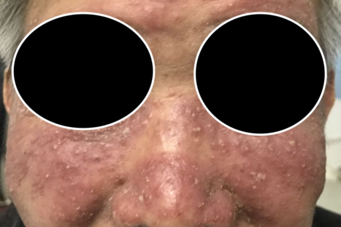 Lupus Miliaris Disseminatus Faciei 颜面粟粒性播散性狼疮