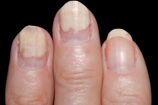 Nail Signs Onycholysis 甲松离