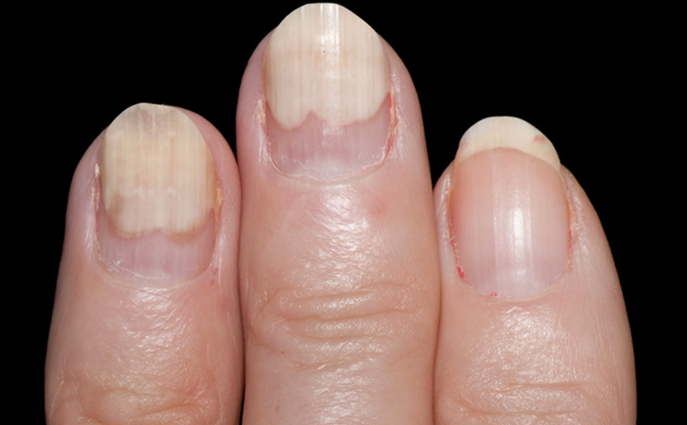 Nail Signs Onycholysis 甲松离