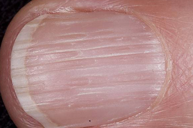 Nail Signs due to abnormal nail matrix function – Onychorrhexis 脆甲症