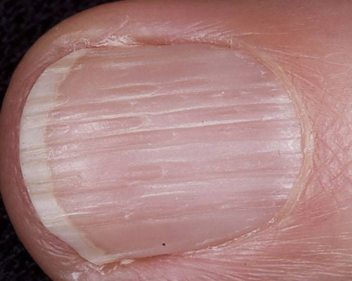 Nail Signs due to abnormal nail matrix function – Onychorrhexis 脆甲症