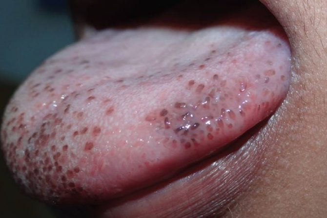 Pigmented Fungiform Papillae on the Tongue 舌上色素沉着的真菌状乳头状突起
