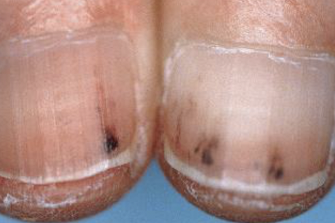 Nail Signs Splinter Haemorrhages 指甲裂片形出血