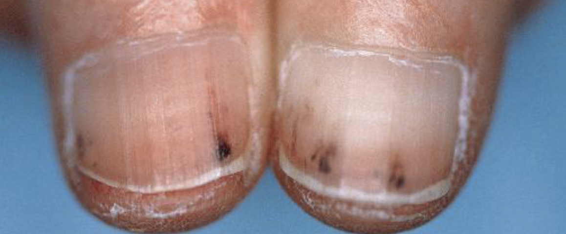 Nail Signs Splinter Haemorrhages 指甲裂片形出血