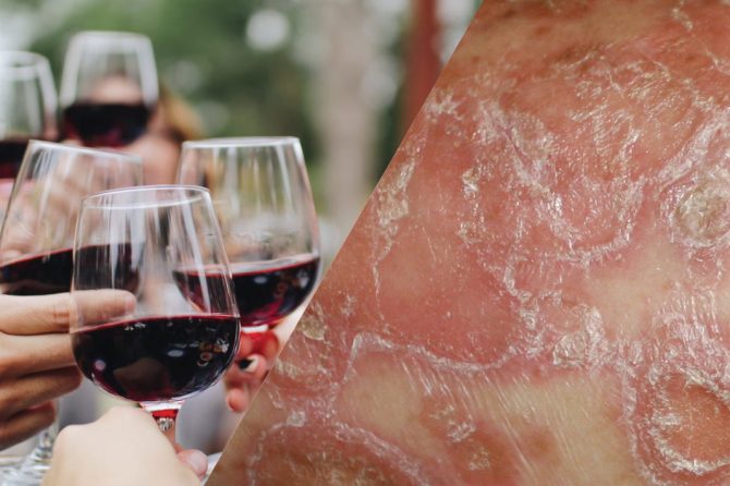 How Alcohol Affect Psoriasis?为什么喝酒会加重银屑病(牛皮癣)？