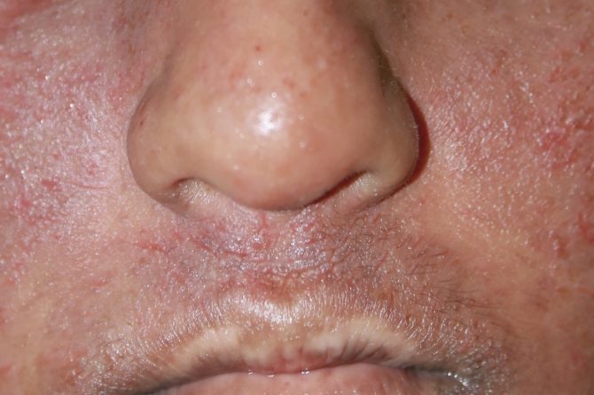What is Atopy? 什么是特异性atopic？