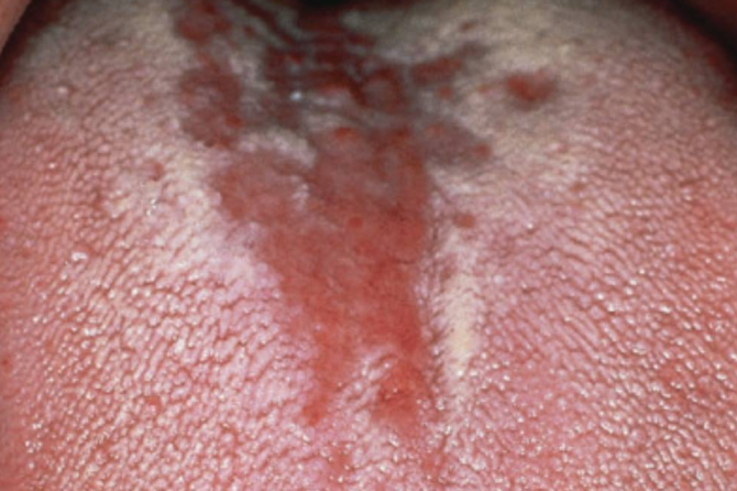 Central Papillary Atrophy 舌中央乳头状萎缩