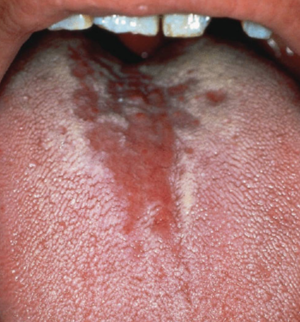 Central Papillary Atrophy 舌中央乳头状萎缩