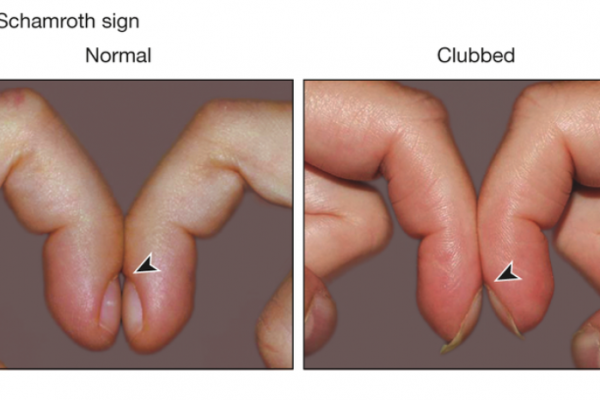 Nail Signs Clubbing 杵状指